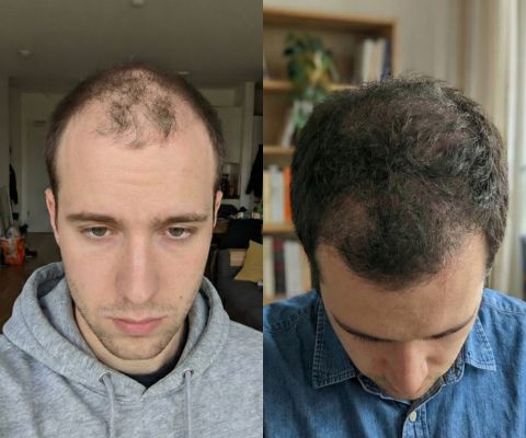 Сравнение роста волос до и после