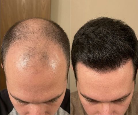 Сравнение роста волос до и после